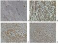 Neuropilin-2 expression in normal breast and breast carcinoma tissue