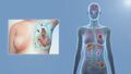 Metastatic or stage 4 breast cancer