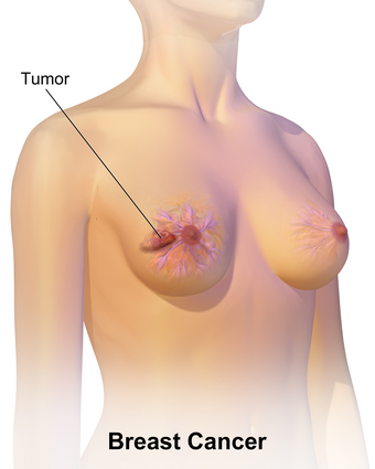 As seen on the image above the breast is already affected with cancer