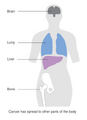 Stage 4 breast cancer