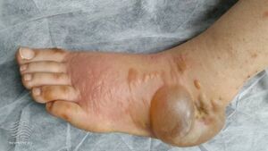 Hand-foot syndrome due to sorafenib