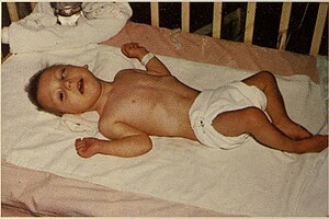 Toxoplasmosis, Congenital.jpg