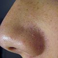 Sebaceous filaments are commonly mistaken for blackheads. Sebaceous Filaments, however, are completely harmless and are a natural part of the skin for people with oily skin.[6]