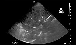 Pneumonia seen by ultrasound[69]