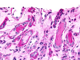 Micrograph showing myeloma cast nephropathy in a kidney biopsy: Hyaline casts are PAS positive (dark pink/red - right of image). Myelomatous casts are PAS negative (pale pink - left of image), PAS stain.