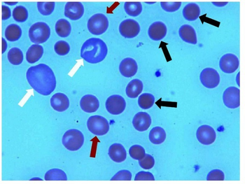 PMC3654623 CRIM.HEMATOLOGY2013-142865.001.png