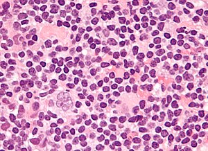 Popcorn cell in nodular lymphocyte predominant Hodgkin lymphoma - very high mag cropped.jpg