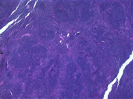 Hodgkin lymphoma, nodular lymphocyte predominant (low power view). Notice the nodular architecture and the areas of "mottling". (H&E)
