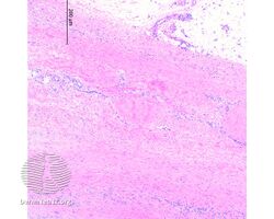 Eosinophilic fasciitis/pathology