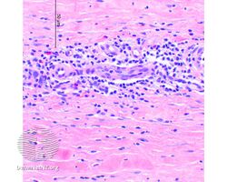 Eosinophilic fasciitis/pathology