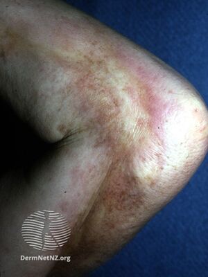 Eosinophilic fasciitis (DermNet NZ dermal-infiltrative-eos-fasc).jpg