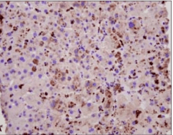 Immunohistochemical staining of liver biopsy specimen, strong cytoplasmic staining for hepatitis A virus antigen was noted