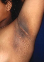 Acanthosis nigricans.png