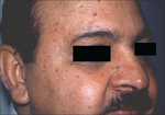Dermatosis papulosa nigra.png