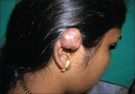 Earlobe keloid.png