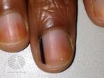 Racial melanonychia (DermNet NZ hair-nails-sweat-melanonychia-16).jpg