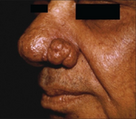 Rhinophyma.png