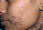 Verrucous epidermal nevus.png