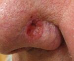 Basal cell carcinoma3.JPG