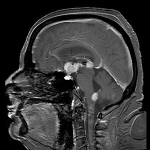 Primary central nervous system B-cell non-Hodgkin lymphoma.jpg