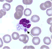 EhrlichiaEwingiiUS CDCMorulaInCytoplasmOfNeutrophil.jpg