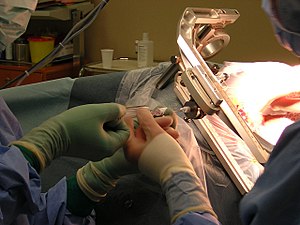 Brain biopsy under stereotaxy.jpg
