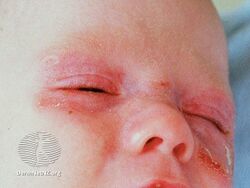 Neonatal lupus