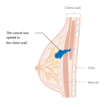Stage 3B breast cancer
