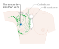 Stage 1A breast cancer