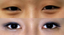 Example of Korean double eyelid surgery