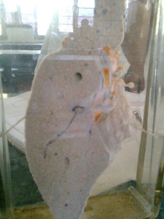 Cirrhosis of liver.jpg