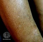 Porcelain-white patch extending peripherally (DermNet NZ guttate-hypomelanosis-2).jpg