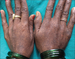 Reticulate acropigmentation of Kitamura (back of hands).png
