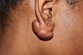 Earlobe aeloid