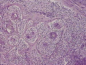SkinTumors-P7080439.JPG