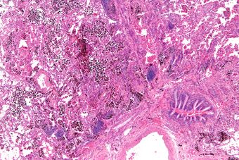 Pulmonary haemorrhage - low mag.jpg