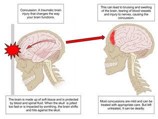 Concussion Anatomy.png