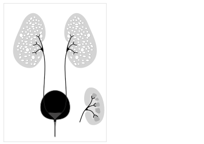 Illustration-Autosomal recessive polycystic kidney disease with a normal kidney inset