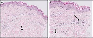 Micrograph of urticaria. Dermal edema [solid arrows in (A,B)] and a sparse superficial predominantly perivascular and interstitial infiltrate of lymphocytes and eosinophils without signs of vasculitis (dashed arrow).[29]