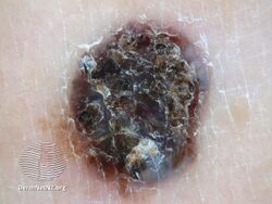 Nodular melanoma dermoscopy (DermNet NZ nodular-melanoma-4).jpg
