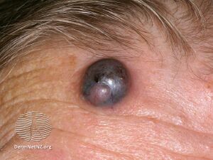 Nodular melanoma (DermNet NZ nm4).jpg