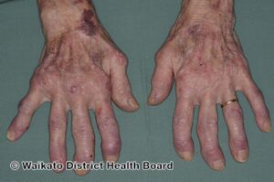 Rheumatoid arthritis