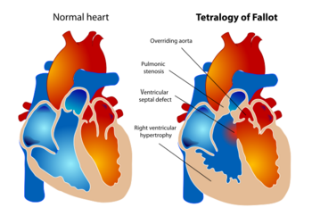 Tetralogy of Fallot.svg