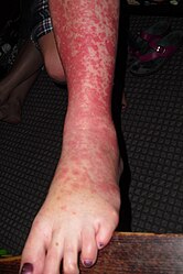 Erythema multiforme target lesions on the leg