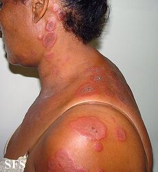 Erythema multiforme