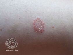 Discoid eczema day 14