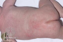 Subcutaneous fat necrosis of the newborn