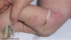 Subcutaneous fat necrosis of the newborn