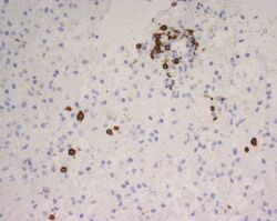 Aggressive multiple sclerosis