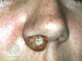 See more images of orf... (DermNet NZ viral-orf-nose).jpg